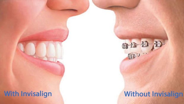 Invisalign in Harrison