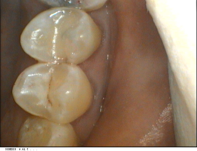 Harrison Before and After Invisalign