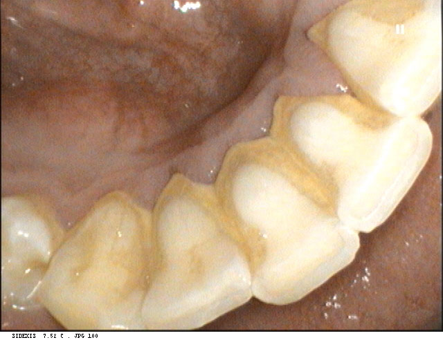 Harrison Before and After Dental Implants